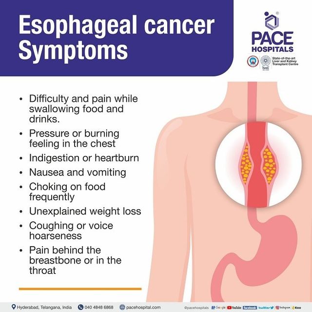 Understanding Esophageal Cancer Causes Symptoms And Prevention